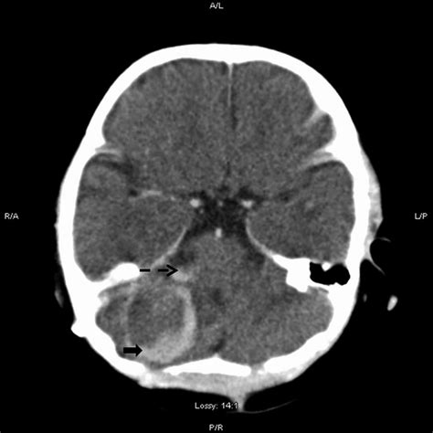 An axial view of CT brain showed a right cerebellar cavernoma (full ...