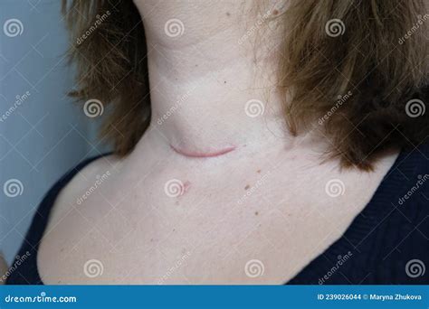 Scar On The Neck Surgical Wounds Removal Of Tumor And Thyroid Cancer