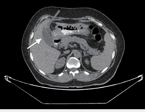 Ct Abdomen Axial View Showing The Duplicated Gall Bladder One Of Them