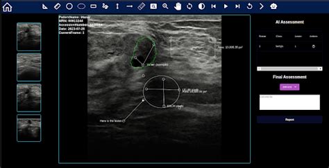 Computer Aided System For Breast Cancer Lesion Segmentation And