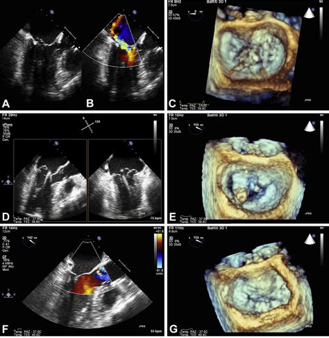 Feasibility Of Anterior Mitral Leaflet Flail Repair With Transapical Beating Heart Neochord