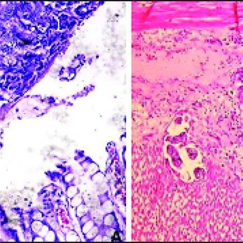 Rectal adenocarcinoma in a dog. Immunohistochemistry of AE1/AE2... | Download Scientific Diagram