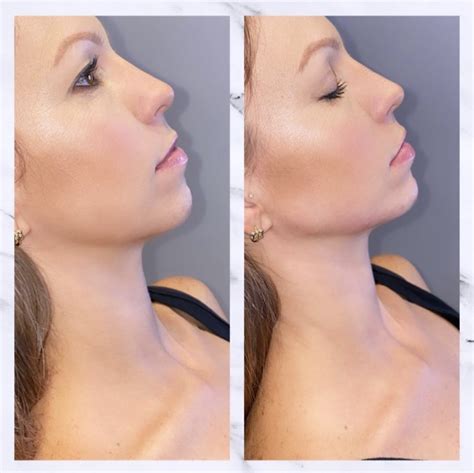 Chin Jawline Fillers In Gilbert Az Colair Med Spa