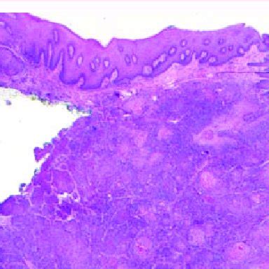 Photomicrograph Showing A Well Differentiated Squamous Cell Carcinoma