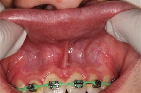 Frenectomy Photo Gallery Dr Mh Abram Periodontist Jhb