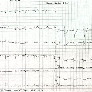 ECG Showing ST Segment Elevation In Leads II III And AVF With