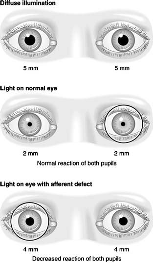 Hippus Pupil Reaction