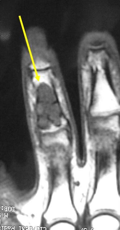 Enchondroma Benign Bone Tumor Tumors Of Bone