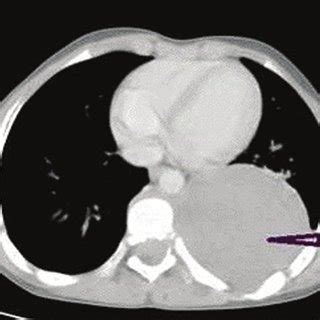 Axial Contrast Enhanced Computed Tomography Image Demonstrating A