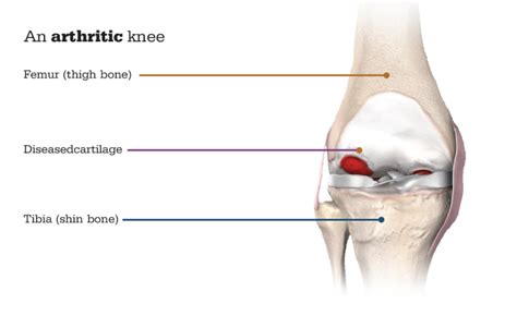 Mako Robotic Total Knee Replacement Dr Hulse