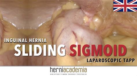 Sliding Sigmoid Laparoscopic Tapp In Inguinal Hernia Youtube