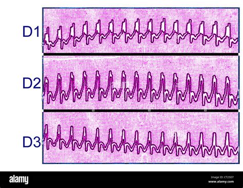 Tachycardia Ecg Hi Res Stock Photography And Images Alamy