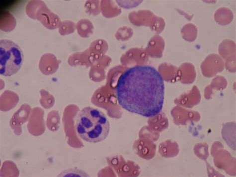 Difference Between Promyelocyte And Myelocyte Compare The Difference