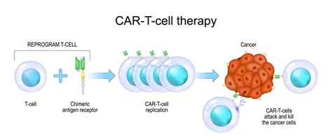 New Hope In Fight Against Glioblastoma Dual Target Car T Cell Therapy