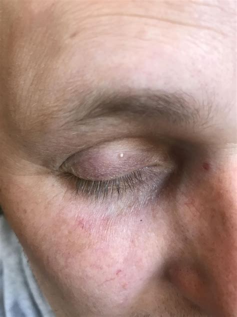 Weird White Spots On Eyelids Rmedicaladvice