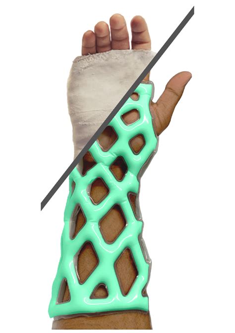 Cast21 Home - Cast21 | It cast, Waterproof casts, Ligament injury