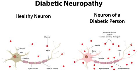 Peripheral Neuropathy Causes And Management Strategies Premier