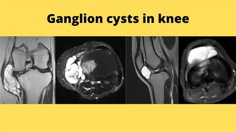 Ganglion Cysts In Knee Part One Youtube