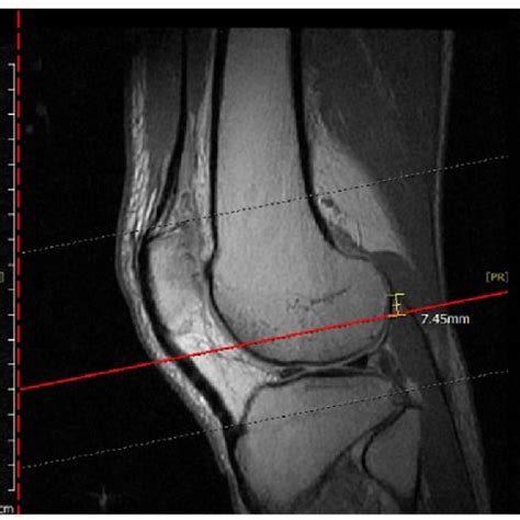 The right knee MRI showed a large fabella bone with subchondral bone ...