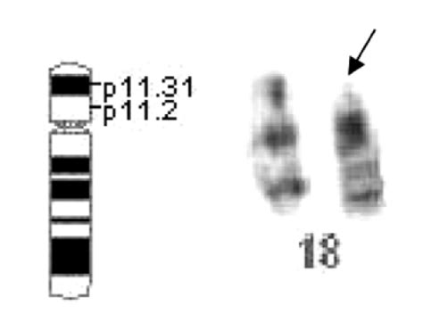 A Standard Diagram Of A Chromosome 18 Left And Partial Karyotype Of Download Scientific