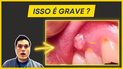 Como Tratar Abscesso Dent Rio Youtube