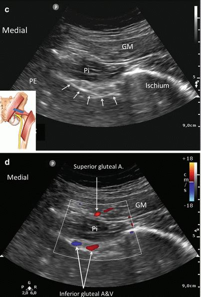 Injection For Piriformis Syndrome Anesthesia Key