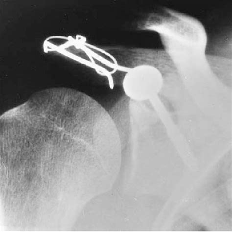 Pdf Fractures Of The Coracoid Process