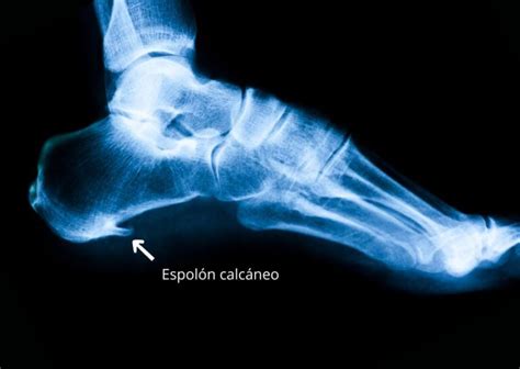 Diferencias Entre el Espolón Calcáneo y la Fascitis Plantar Centro