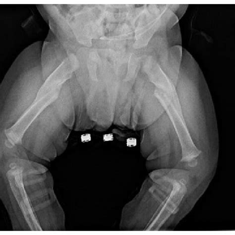 Frog Leg Radiograph Month After Hospital Discharge Demonstrating