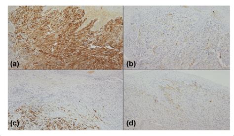 Positive Immunohistochemical Stains The Tumour Cells Are Stained Brown