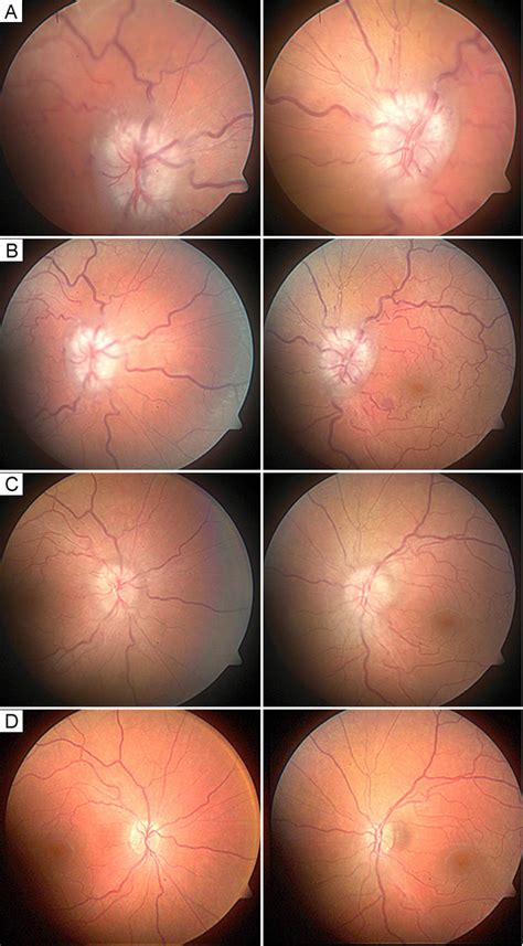 Fundus Images Of The Right Eye Left Column And Left Eye Right