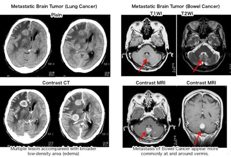 Metastatic Brain Cancer Life Expectancy | Renew Physical Therapy