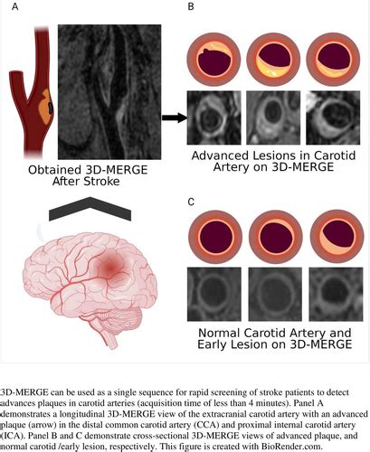 Detection Of Advanced Lesions Of Atherosclerosis In Carotid Arteries