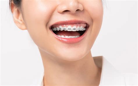 Traditional Metal Braces Ldn Dental Amazing Reviews