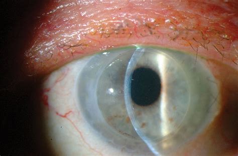 The Long And Short Of Corneal Preservation Times Tecfen Medical