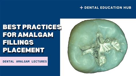 Best Practices For Amalgam Filling Placement YouTube