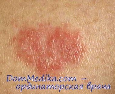 Болезнь Боуэна и рак Педжета: диагностика, лечение