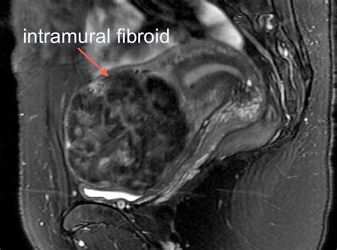 Fibroids Ufe Body Mri