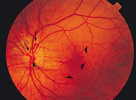 Chorioretinal Vascular Abnormalities Associated With Angioid Streaks