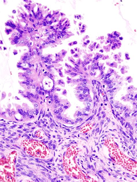 Filemucinous Borderline Tumor Of Ovary 1 Histopatholgy Wikimedia Commons