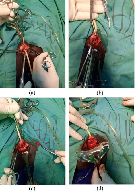 Vesicovaginal Fistula Repair