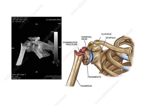 Fracture of the neck of the humerus - Stock Image - C021/0789 - Science Photo Library