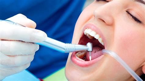 Las 9 Dudas MÁs Frecuentes Sobre La Limpieza Dental Perudentus