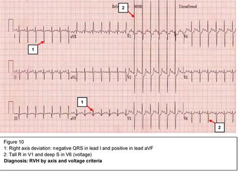 EKG Interpretation