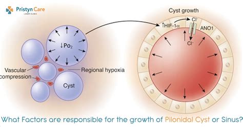 Diagram Of Pilonidal Cyst