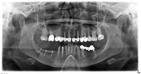 Остеопластика — всего одна операция. — IMPLANT-IN.COM — дентальная ...
