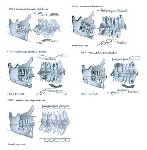 Sequence Of Class Ii Deep Bite Treatment Sato 2008 Step Fourfive Download Scientific