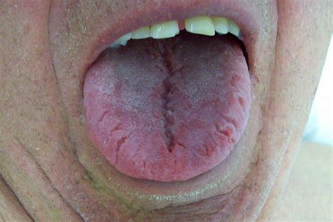 Sore White Bumps On Tongue