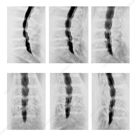 Lateral Subarticular Recess Stenosis, MRM - Stock Image - C030/6491 ...