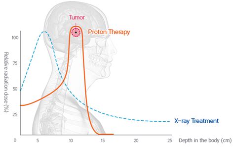 Proton Beam And Neutron Radiotherapy - The Best Picture Of Beam